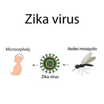 Zika virus. Mosquito bite. Microcephaly in the infant. Infographics. Vector Stock Illustration
