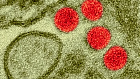Zika virus, TEM Stock Footage 79704888