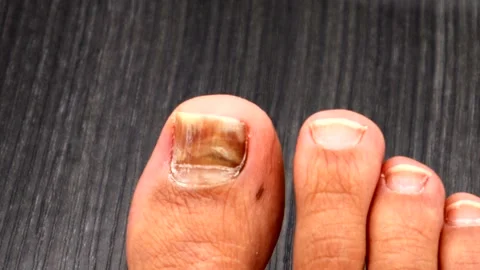 Zoom in on a fingernail that has turned black due to injury. Stock Footage 335250224