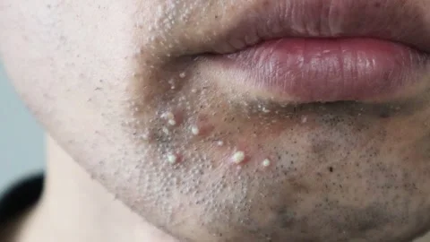 Zoom in on a man's rough skin Video stock 326088274