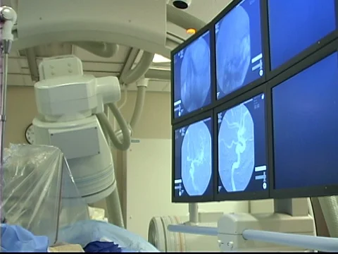 Zoom in to monitors imaging neuroendoscopy procedure Stock Footage