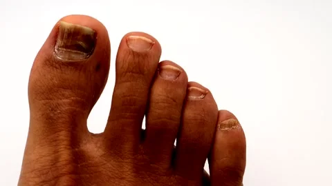 Zoom in on a toenail that has turned black due to injury. Stock-Footage 335242928
