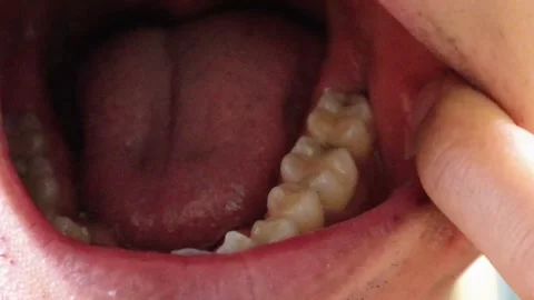 Zoom-in video of a cavity Stock Footage 323501407