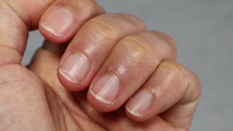 Zoom-in video of cracked nails Stock-Footage 324549054